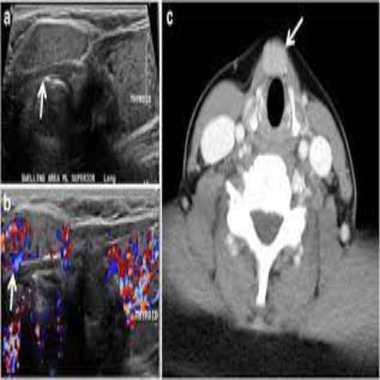 Thyroid Color Doppler? What It Is, Purpose, Procedure and Results